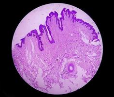 Histological biopsy of Scrotal wall under microscopy showing Calcinosis cutis. Scrotal calcinosis. Calcinosis cutis of scrotum photo