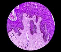 Biopsia histológica de pared escrotal bajo microscopía que muestra calcinosis cutis. calcinosis escrotal. calcinosis cutis del escroto foto