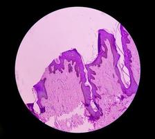 Biopsia histológica de pared escrotal bajo microscopía que muestra calcinosis cutis. calcinosis escrotal. calcinosis cutis del escroto foto