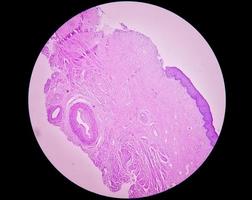 examen histológico de biopsia de útero sugestiva de prolapso uterino. cervicitis crónica con prolapso. foto