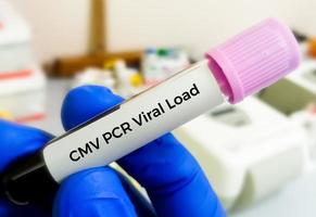 Cytomegalovirus or CMV PCR viral load for DNA Detection and Quantification photo