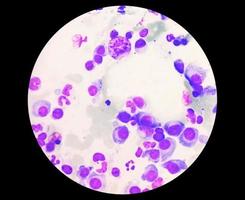 Microscopic view of bone marrow slide feature are suggestive Multiple myeloma, also known as myeloma, is a type of bone marrow cancer. photo