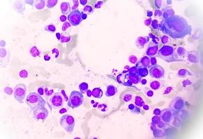 Microscopic view of bone marrow slide feature are suggestive Multiple myeloma, also known as myeloma, is a type of bone marrow cancer. photo