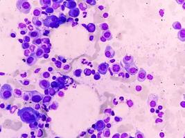 Microscopic view of bone marrow slide feature are suggestive Multiple myeloma, also known as myeloma, is a type of bone marrow cancer. photo