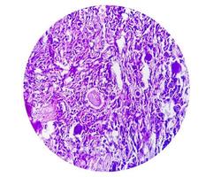 Spinal tumor biopsy showing Psammomatous meningioma. Psammoma bodies. photo