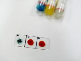 A Negative blood type, one of the rare blood group in worldwide. Blood group and Rh factor testing by slide agglutination method. photo