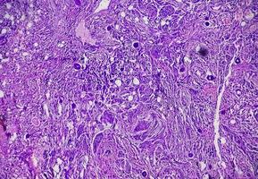 Biopsia de tumor espinal que muestra meningioma psamomatoso. cuerpos de psammoma. foto