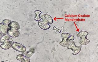 Microscopic image showing calcium oxalate monohydrate  from urine sediment. UTI. kidney disease.. photo