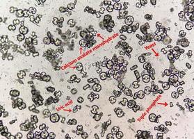 imagen microscópica que muestra monohidrato de oxalato de calcio, cristales de ácido úrico y cristales de fosfato triple del sedimento de orina. uti enfermedad del riñon. foto