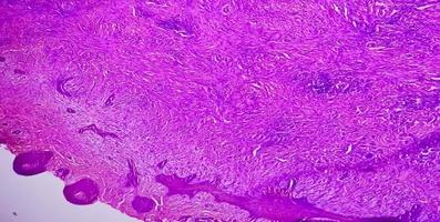 biopsia de piel, sugestiva de carcinoma de células basales, el tipo más común de cáncer de piel. foto