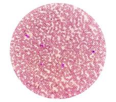 Microscopic view of hematological stained slide. thrombocytopenia. Extremely low level of platelet count in blood. photo