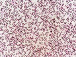 vista microscópica del portaobjetos teñido hematológico. trombocitopenia. nivel extremadamente bajo de recuento de plaquetas en la sangre. foto