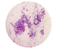 Microscopic view of PAP'S smear showing severe negative for intraepithelial lesion malignancy or NILM.  cervical cancer diagnosis. photo