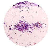 Microscopic view of PAP'S smear showing severe negative for intraepithelial lesion malignancy or NILM.  cervical cancer diagnosis. photo