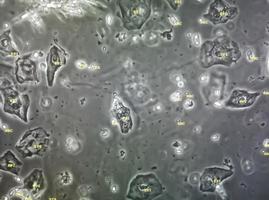 Microscopic image of abnormal urinalysis. urine exam. Urine routine examination. photo