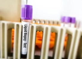 Blood samples for Liquid biopsy blood test to detect cancer cells or DNA fragments that circulate in the bloodstream, Lung cancer, laboratory background. photo