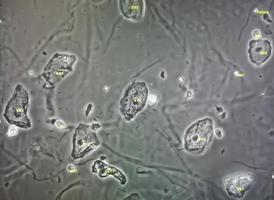 Microscopic image of abnormal urinalysis. urine exam. Urine routine examination. photo