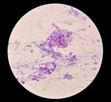 Microscopic view of PAP'S smear showing severe negative for intraepithelial lesion malignancy or NILM.  cervical cancer diagnosis. photo