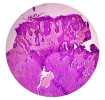 Skin biopsy, Suggestive of Basal cell carcinoma, the most common type of skin cancer. photo