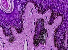 Biopsia histológica de pared escrotal bajo microscopía que muestra calcinosis cutis. calcinosis escrotal. calcinosis cutis del escroto foto