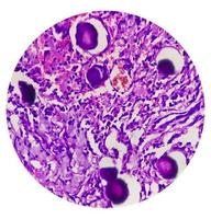 Spinal tumor biopsy showing Psammomatous meningioma. Psammoma bodies. photo