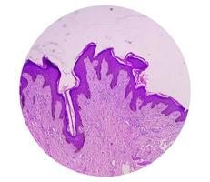 Biopsia histológica de pared escrotal bajo microscopía que muestra calcinosis cutis. calcinosis escrotal. calcinosis cutis del escroto foto