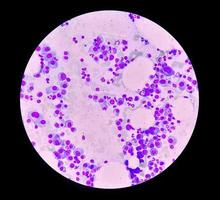 Microscopic view of bone marrow slide feature are suggestive Multiple myeloma, also known as myeloma, is a type of bone marrow cancer. photo