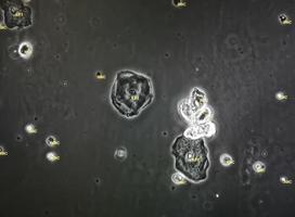 Microscopic image of abnormal urinalysis. urine exam. Urine routine examination. photo