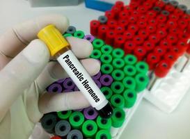 Blood sample for Pancreatic Hormone test. Insulin, Glucagon photo