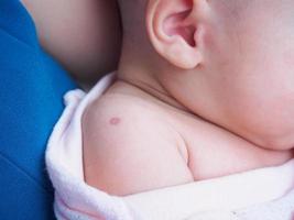 vaccination reaction of Bacillus Calmette Guerin BCG vaccine on newborn baby shoulder photo