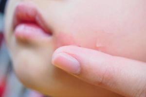 madre aplicando crema antihistamínica tópica en la cara del niño con erupción cutánea y alergia con mancha roja causada por picadura de mosquito foto