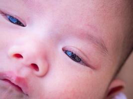 newborn baby with allergy on face photo