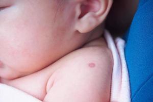 vaccination reaction of Bacillus Calmette Guerin BCG vaccine on newborn baby shoulder photo