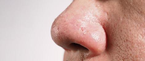 Acne and problem pores. White and blackhead pimples from nose pores. photo