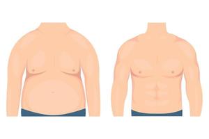 Vector illustration of a man's torso before and after losing weight and exercising. Foreground. For medical publications and advertising of cosmetic, plastic procedures
