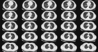 Computed tomography of the lungs in a healthy adult man. Normal lungs ct scan. May be part of COVID-19 diagnostic. photo