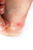 Blister on heel gets pricked with needle to burst it on white background, close-up with selective focus. photo