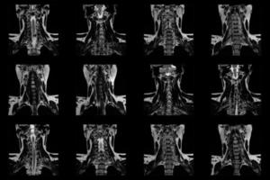 set of coronal MRI scans of neck area of caucasian male with bilateral paramedial extrusion of the C6-C7 segment with radiculopathy photo