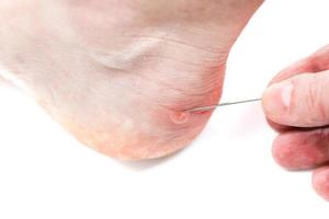 Blister on heel gets pricked with needle to burst it on white background, close-up with selective focus. photo