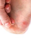 Blister on heel gets pricked with needle to burst it on white background, close-up with selective focus. photo