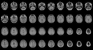 set of serial MRI scans of sixty years old caucasian female head photo