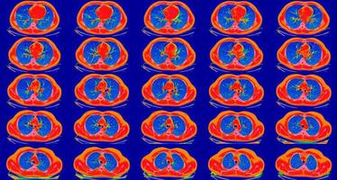 Computed tomography of the lungs in a healthy adult man. Normal lungs ct scan, spectral toned. May be part of COVID-19 diagnostic. photo