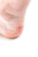 Small unpopped blister on heel, isolated on white background, close-up with selective focus. photo