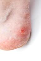 Small unpopped blister on heel, isolated on white background, close-up with selective focus. photo