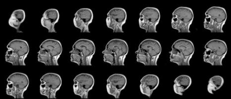 conjunto de resonancias magnéticas en serie de cabeza femenina caucásica de sesenta años en plano sagital o longitudinal foto