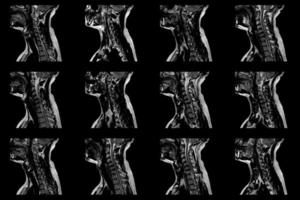 set of sagittal MRI scans of neck area of caucasian male with bilateral paramedial extrusion of the C6-C7 segment with radiculopathy photo