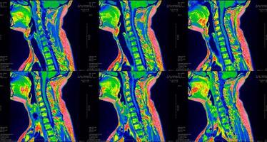 set of 6 sagittal green colored MRI scans of neck area of caucasian 34 years old male with bilateral paramedial extrusion of the C6-C7 segment photo