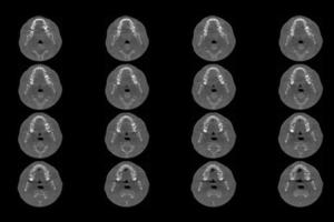 Set of MRI scanner slices of dental part of human male scull with multiple problems on white background. photo