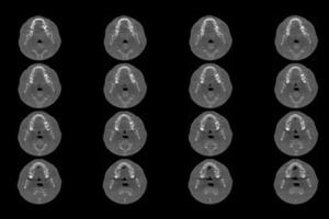 Set of MRI scanner slices of dental part of human male scull with multiple problems on white background. photo