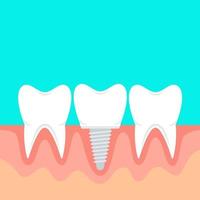 Human teeth and dental implant. Vector stock illustration in flat style with copy space.